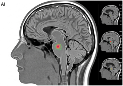 یه ابزار هوش مصنوعی جدید، ضایعه‌های مغزی پنهانی رو که دکترا تو بچه‌های مبتلا به صرع نمی‌بینن، پیدا می‌کونه